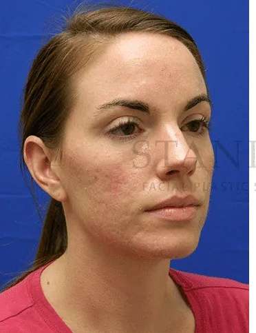 Acne Scarring Before & After Patient #7818
