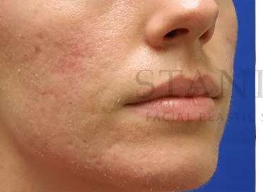 Acne Scarring Before & After Patient #7818