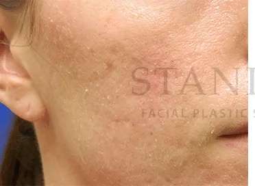 Acne Scarring Before & After Patient #7818
