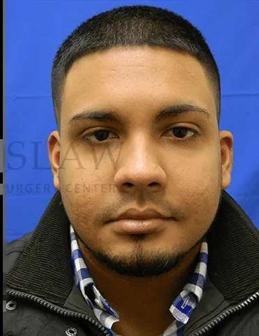 Acne Scarring Before & After Patient #7792