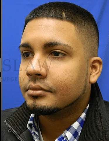 Acne Scarring Before & After Patient #7792