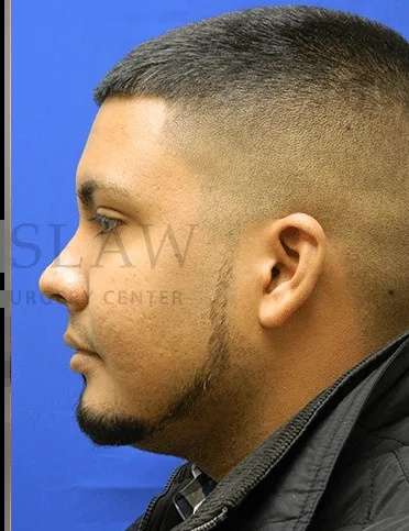 Acne Scarring Before & After Patient #7792