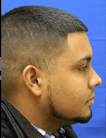 Acne Scarring Before & After Patient #7792
