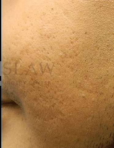 Acne Scarring Before & After Patient #7792