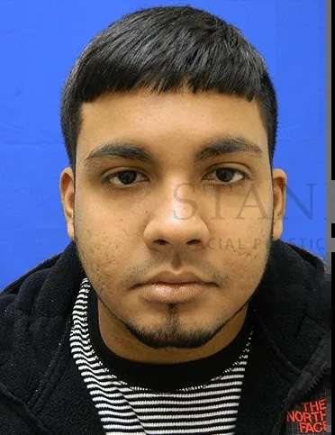 Acne Scarring Before & After Patient #7792