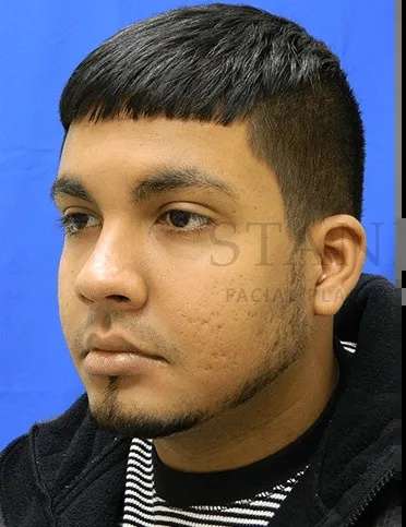 Acne Scarring Before & After Patient #7792