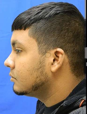 Acne Scarring Before & After Patient #7792