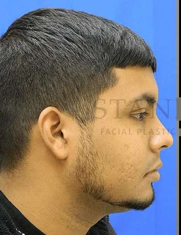 Acne Scarring Before & After Patient #7792