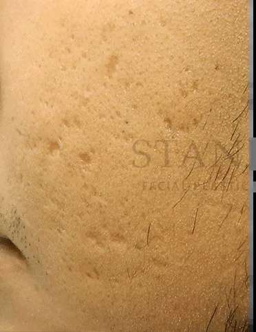 Acne Scarring Before & After Patient #7792