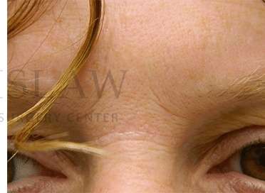 Benign Lesions Before & After Patient #7865