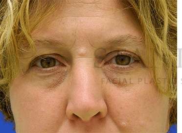 Benign Lesions Before & After Patient #7865