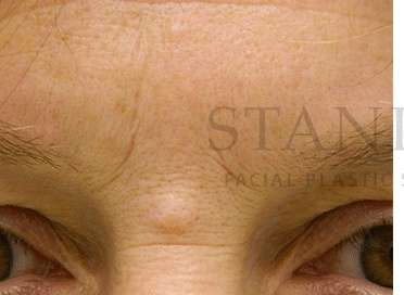 Benign Lesions Before & After Patient #7865