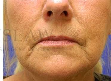 Benign Lesions Before & After Patient #7874