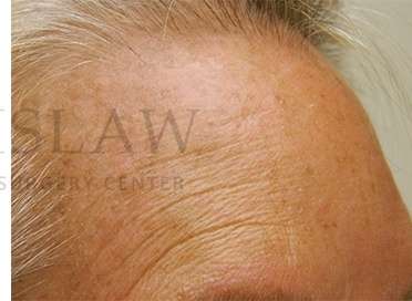 Benign Lesions Before & After Patient #7874