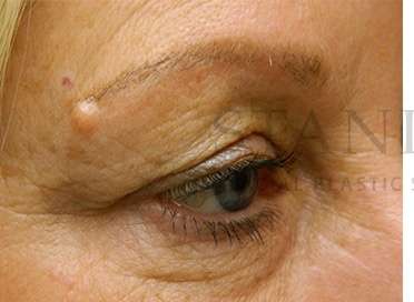 Benign Lesions Before & After Patient #7874