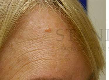 Benign Lesions Before & After Patient #7874