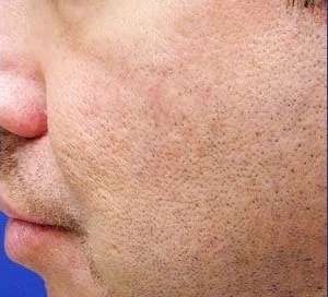 Restylane Before & After Patient #7907