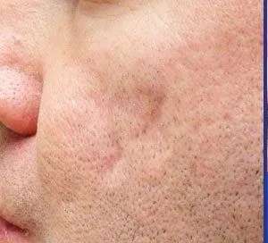 Restylane Before & After Patient #7907