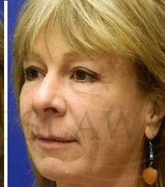 Perlane Before & After Patient #7917
