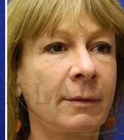 Perlane Before & After Patient #7917