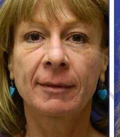 Perlane Before & After Patient #7917