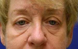 Perlane Before & After Patient #7882