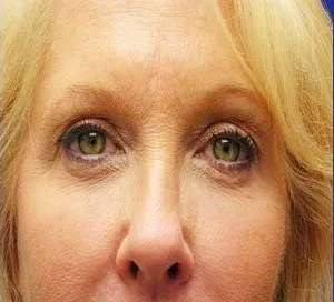 Perlane Before & After Patient #7926