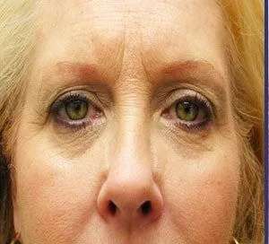 Perlane Before & After Patient #7926