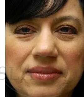 Restylane Before & After Patient #7899