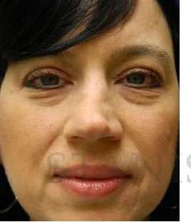 Perlane Before & After Patient #7890