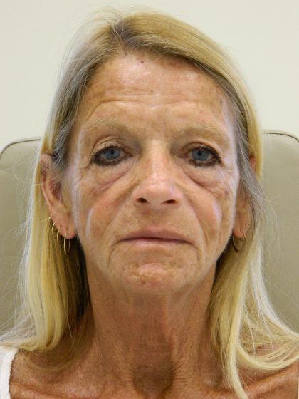 Face/Neck Lift Before & After Patient #8479