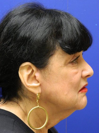 Face/Neck Lift Before & After Patient #8315