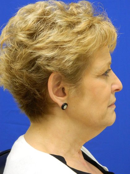 Face/Neck Lift Before & After Patient #8293