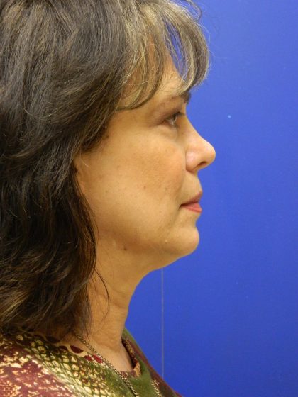 Face/Neck Lift Before & After Patient #8341