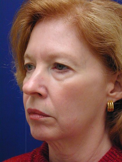 Face/Neck Lift Before & After Patient #8380