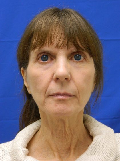Face/Neck Lift Before & After Patient #8304