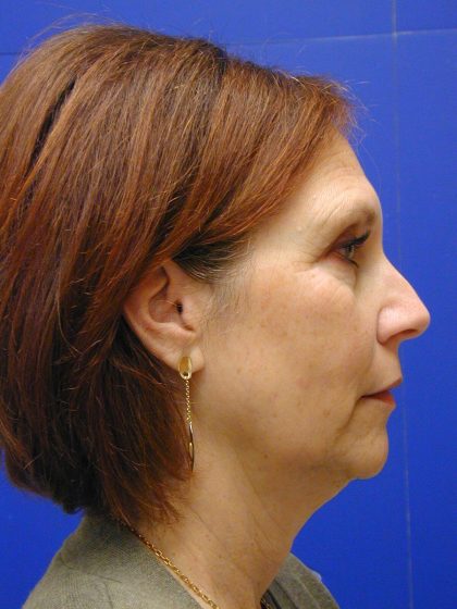 Face/Neck Lift Before & After Patient #8446