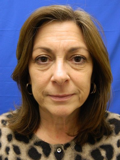 Face/Neck Lift Before & After Patient #8459