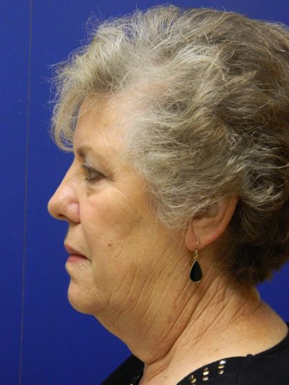 Face/Neck Lift Before & After Patient #8470