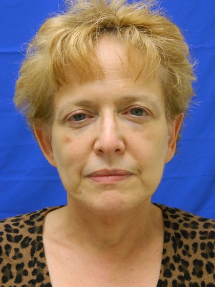Face/Neck Lift Before & After Patient #8293