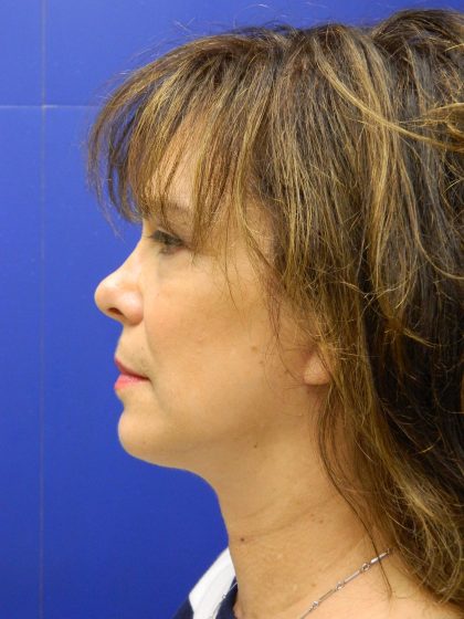 Face/Neck Lift Before & After Patient #8341