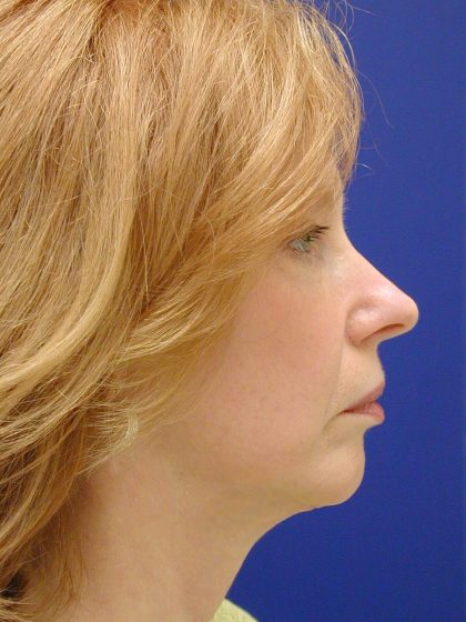 Face/Neck Lift Before & After Patient #8380