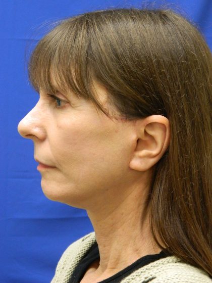 Face/Neck Lift Before & After Patient #8304