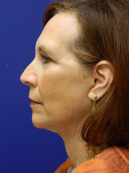 Face/Neck Lift Before & After Patient #8446