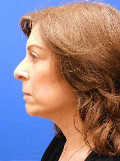 Face/Neck Lift Before & After Patient #8459