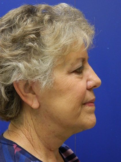 Face/Neck Lift Before & After Patient #8470