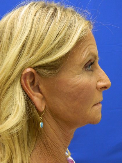 Face/Neck Lift Before & After Patient #8479