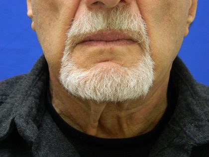 Face/Neck Lift Before & After Patient #8361
