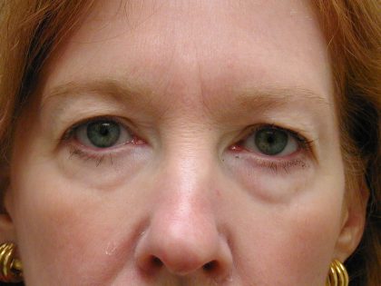 Face/Neck Lift Before & After Patient #8380