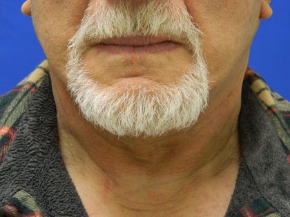 Face/Neck Lift Before & After Patient #8361